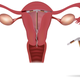 Illustration for article titled Why Are Some Men Pulling Out Womens IUDs?